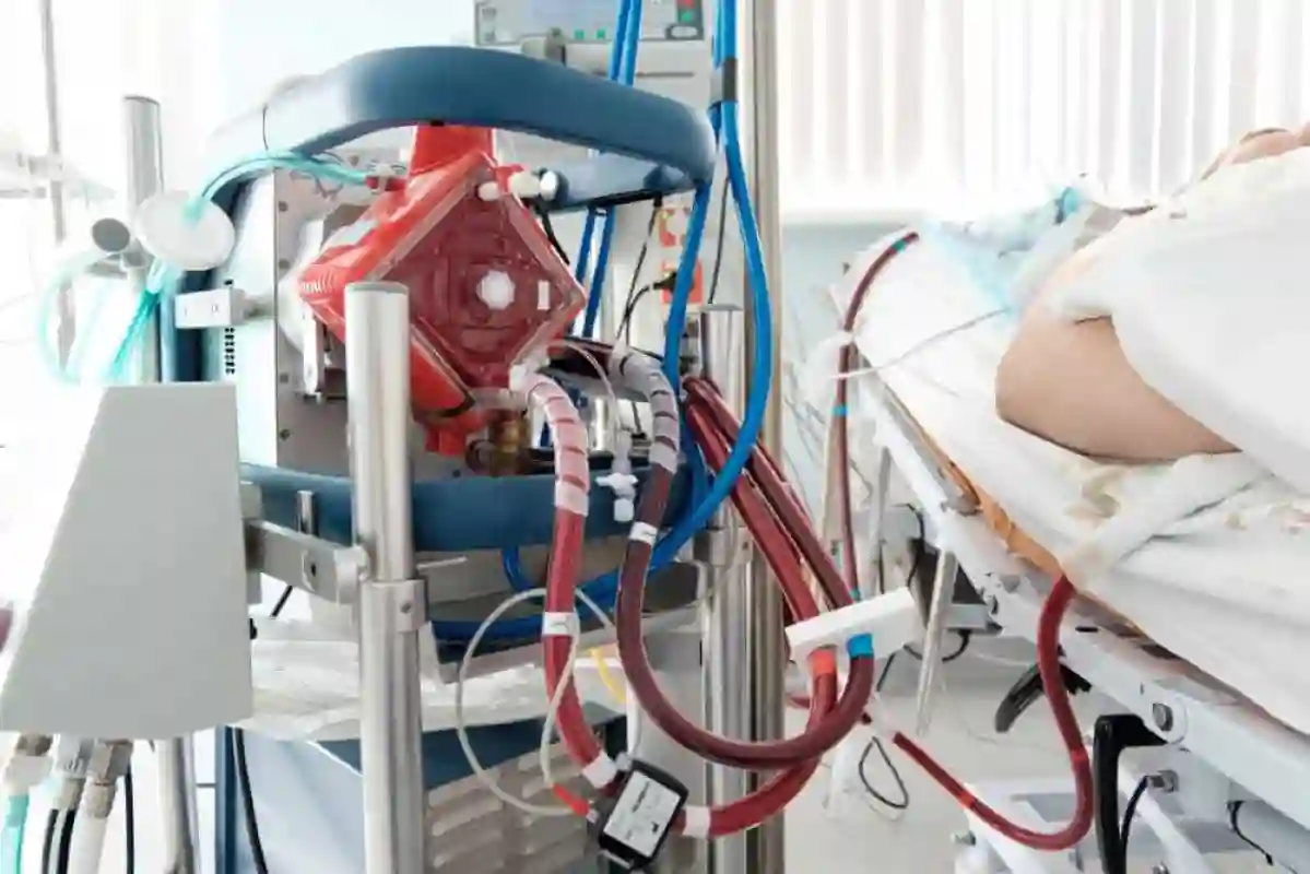 تقنية ECMO