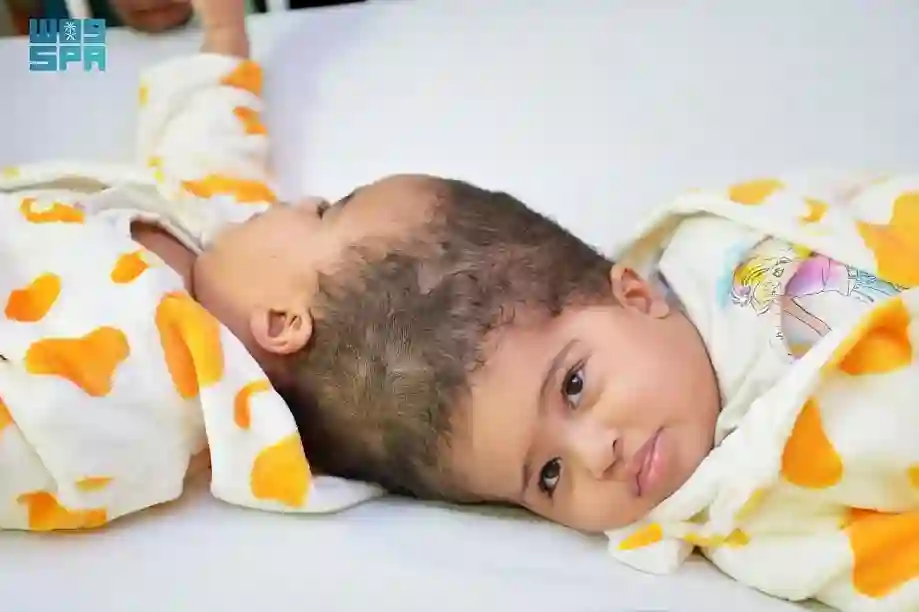 فصل ناجح للتوأم الإريتري المتلاصق